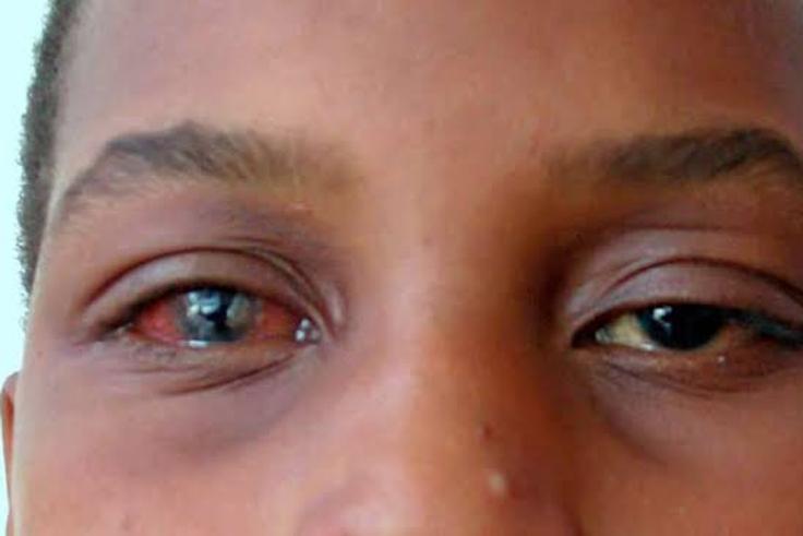 Une épidémie de conjonctivite explose à 48 h de la rentrée scolaire