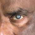 Cataracte : une maladie oculaire fréquente aux origines multiples