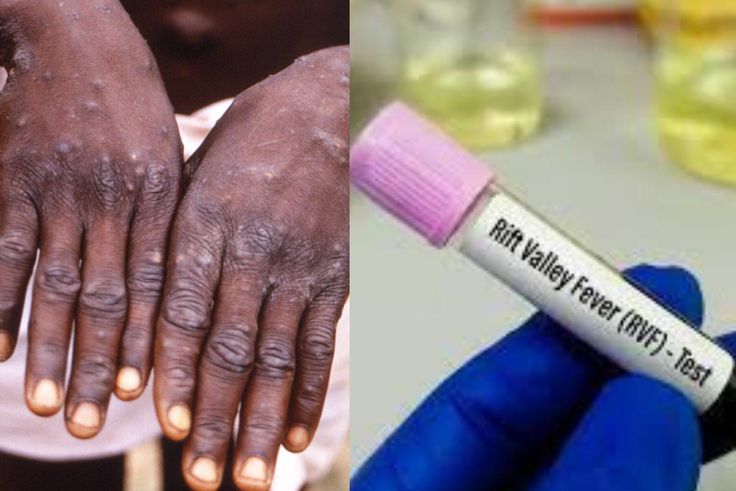 Vélingara : premier cas de la vallée du Rift confirmé