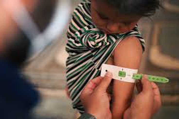 Diabète de type 5 : ce nouveau diabète lié à la malnutrition !