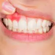 Parodontite : une maladie des gencives aux conséquences bien au-delà de la bouche