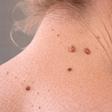 Acrochordons : couper ou arracher ces petites boules de peau peut avoir des conséquences