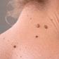 Acrochordons : couper ou arracher ces petites boules de peau peut avoir des conséquences