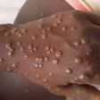 Mpox au Sénégal : 20 contacts identifiés après un nouveau cas confirmé à Dakar