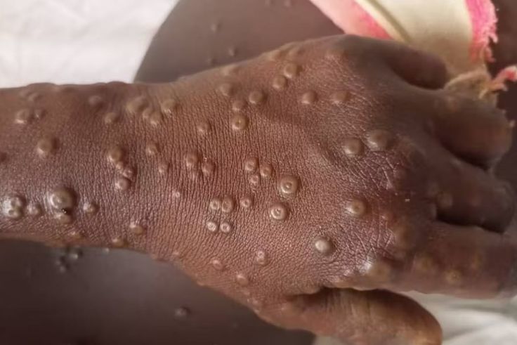 Mpox au Sénégal : 20 contacts identifiés après un nouveau cas confirmé à Dakar