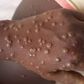 Mpox au Sénégal : 20 contacts identifiés après un nouveau cas confirmé à Dakar
