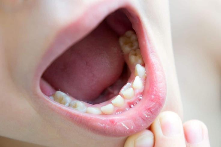 Dents des enfants : Les erreurs qui coûtent cher plus tard !