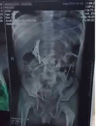 The scan reportedly revealed metallic objects inside his stomach