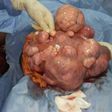 Medical doctor explains correlation between giving birth and fibroids