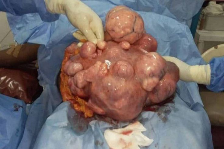 Medical doctor explains correlation between giving birth and fibroids