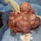 Medical doctor explains correlation between giving birth and fibroids