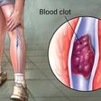 Blood Clots: The silent killer you need to watch – causes, prevention, and impact in Africa