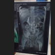 Doctors use magnets to extract needles from child's stomach after horrific abuse