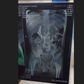 Doctors use magnets to extract needles from child's stomach after horrific abuse