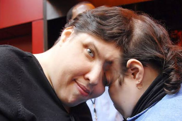 Conjoined twins Lori and George Schapell