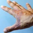 A burn hand Photo/Courtesy