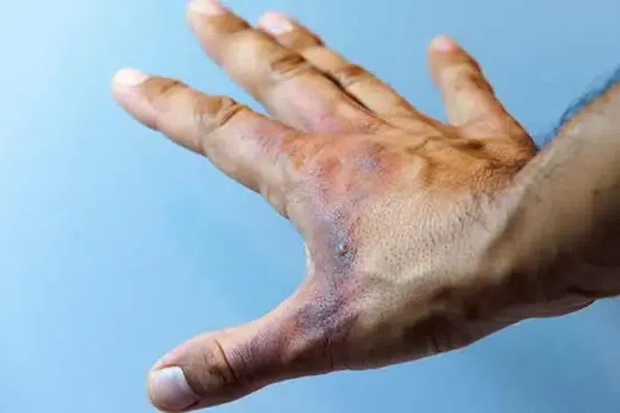 A burn hand Photo/Courtesy