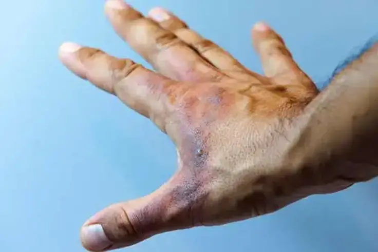 A burn hand Photo/Courtesy