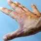 A burn hand Photo/Courtesy