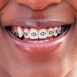 Teeth braces side effects: What you should know before getting them