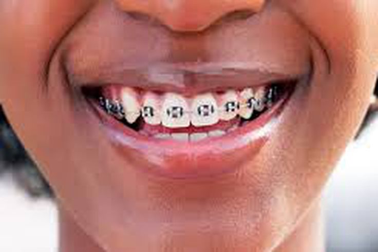 Teeth braces side effects: What you should know before getting them