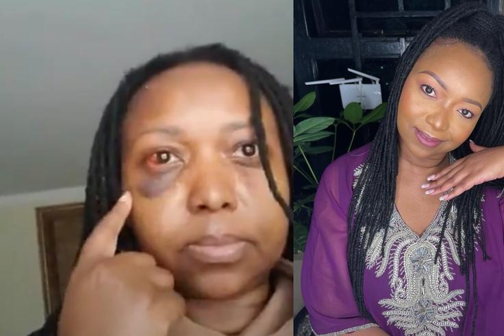 Ciku Muiruri Shares Video of Black Eye, Injuries After Alleged Assault in Thika Land Dispute