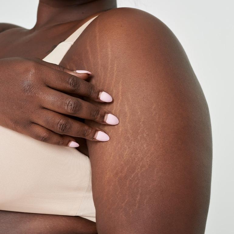 Stretch marks on the upper arm.