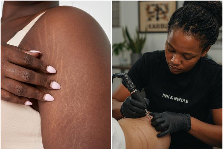 Can tattoos hide stretch marks?: Skin-tone technique people are embracing