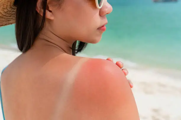 Entre los principales peligros destacan las quemaduras solares. / iStock