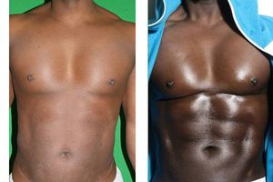 Se hace 'la lipo' por amor a su mujer