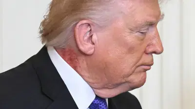 Marca roja en el cuello de Trump genera dudas sobre su salud y desata especulaciones en redes