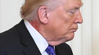 Marca roja en el cuello de Trump genera dudas sobre su salud y desata especulaciones en redes