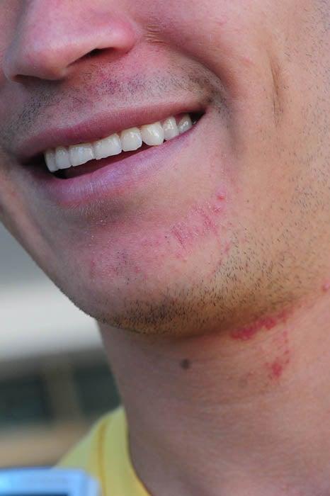 Enríquez aún tiene raspones en el rostro. FOTO: EVA BECERRA