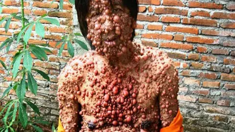 La extraña enfermedad del 'hombre burbuja'