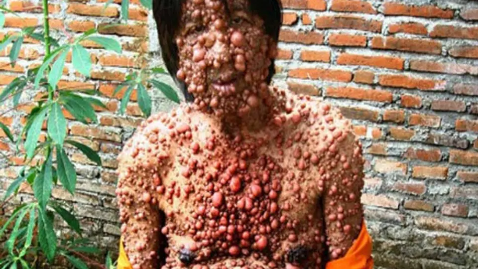 La extraña enfermedad del 'hombre burbuja'