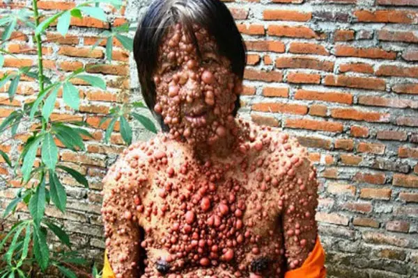 La extraña enfermedad del 'hombre burbuja'
