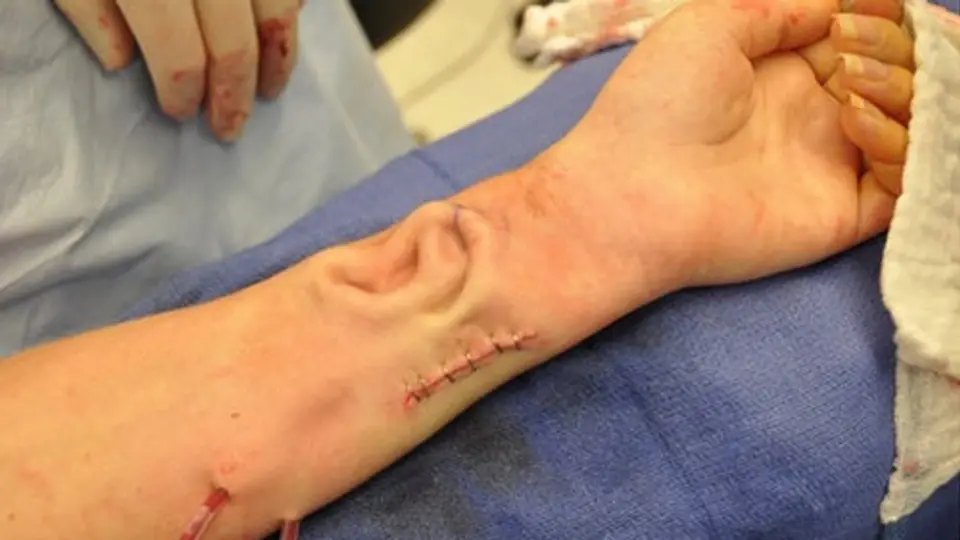 Le creció una oreja ¡en el brazo!