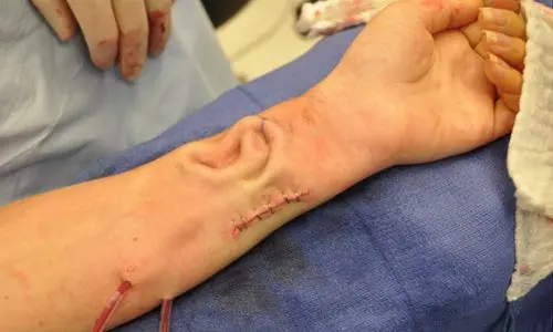 Le creció una oreja ¡en el brazo!