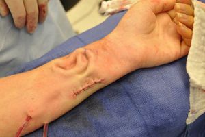 Le creció una oreja ¡en el brazo!