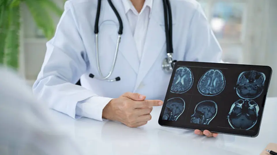 Causas por derrame cerebral. / istock