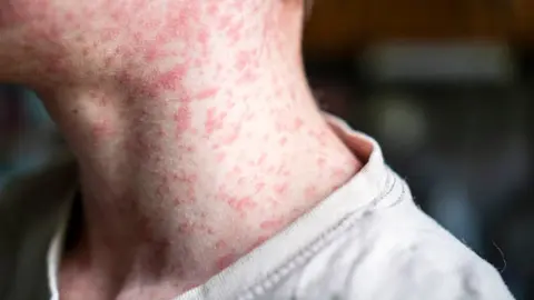 OPS alerta por sarampión en América y México lidera contagios