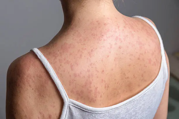 La OPS emitió una alerta epidemiológica por el aumento de casos de sarampión en América./ Pixabay