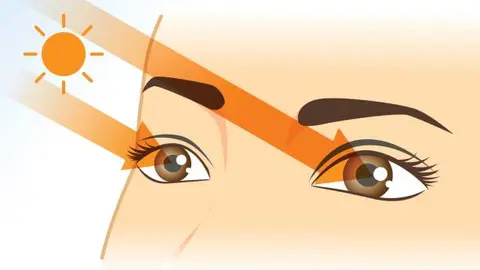 La exposición prolongada al sol sin protección aumenta el riesgo de daño ocular y visión borrosa. / iStock