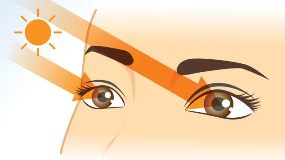 La exposición prolongada al sol sin protección aumenta el riesgo de daño ocular y visión borrosa. / iStock