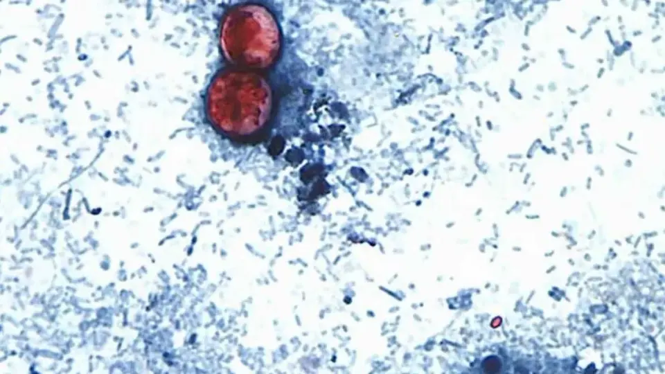 Existe un fuerte aumento de las infecciones por cyclospora entre las personas que regresan de México /Crédito: @MelanieMoser