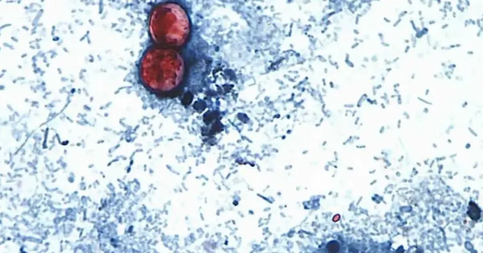 Existe un fuerte aumento de las infecciones por cyclospora entre las personas que regresan de México /Crédito: @MelanieMoser