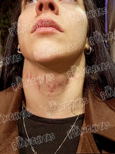 Estas fueron las marcas sobre el cuello que sufrió Stephanie Vaquer luego del ataque de Cuatrero/X: @elplanchitas