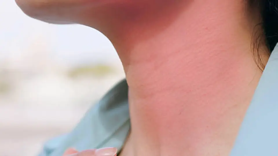 Un desinflamatorio le quemo el cuello ala conductora tras una intervención estética. / istock