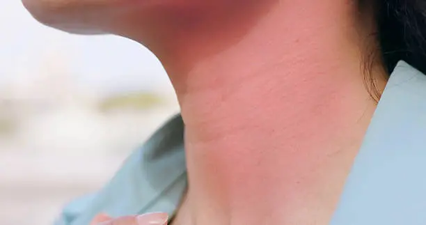 Un desinflamatorio le quemo el cuello ala conductora tras una intervención estética. / istock