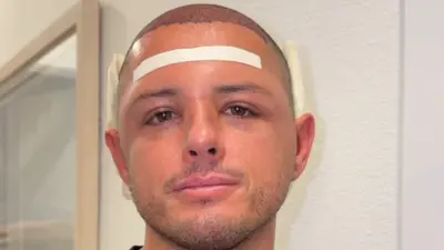 Javier 'Chicharito' Hernández sorprende en redes tras mostrar los avances de su tratamiento capilar